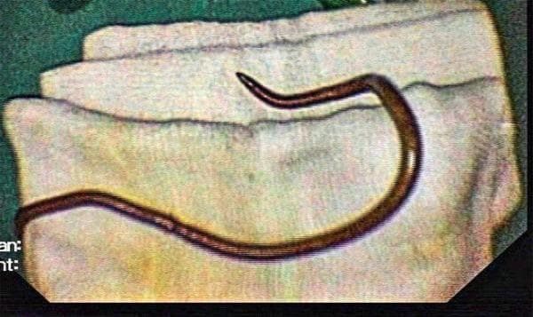 This clinical photograph displays a specimen of Ascaris lumbricoides, a human parasitic roundworm, following extraction via Endoscopic Retrograde Cholangio-Pancreaticography (ERCP). The specimen is a single, elongated, cylindrical nematode with a smooth, tan-to-brownish exterior. One visible extremity tapers to a sharp, curved point, which is characteristic of the adult worm's morphology. The organism is placed on sterile white surgical gauze, illustrating the outcome of a procedural intervention for biliary ascariasis. This image demonstrates the clinical manifestation of hepatobiliary parasitism where a nematode has migrated into the common bile duct, potentially causing obstructive jaundice or biliary colic. The educational focus is on the macroscopic identification of common helminthic infections and the visual confirmation of parasitic extraction in gastroenterology and tropical medicine.