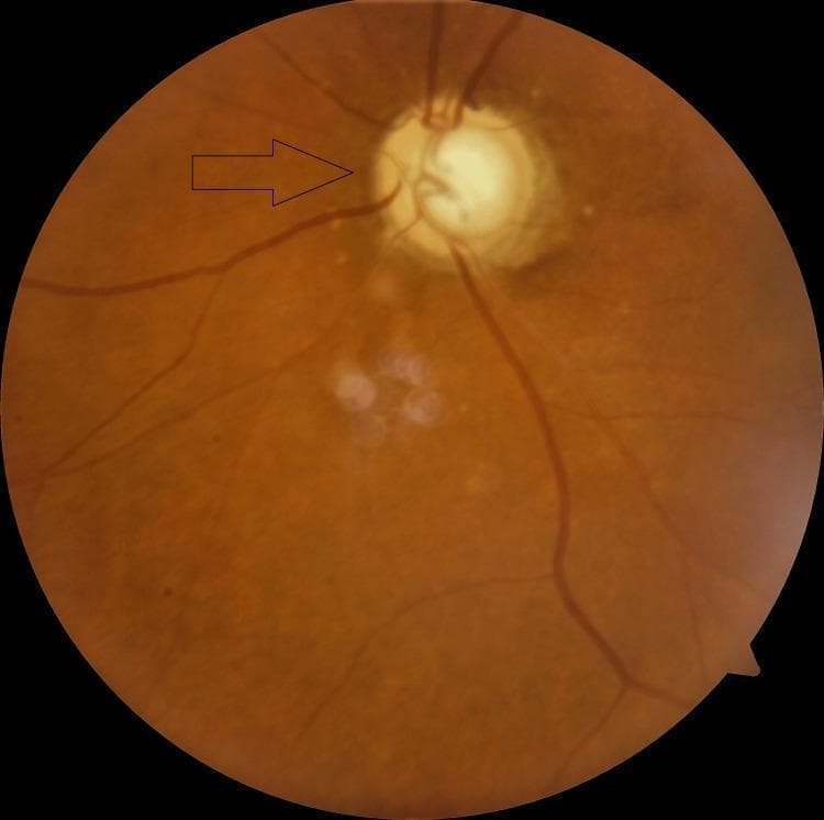 This clinical fundus photograph depicts the posterior pole of the left eye, highlighting significant structural changes to the optic nerve head (ONH). The optic disc exhibits advanced glaucomatous cupping, characterized by a nearly total cup-to-disc ratio (approximately 0.99). The neuroretinal rim is severely thinned and pale, with an arrow indicating the baring of a circumlinear vessel and nasalization of the retinal vasculature. The central cup is deep and markedly enlarged, consistent with end-stage glaucoma. Surrounding the optic disc, there is evidence of peripapillary atrophy. The background fundus shows a reddish-orange hue with several small, yellowish-white lesions localized inferior to the optic disc, which may represent drusen or focal retinal changes. Retinal vessels emerge from the disc with relatively normal caliber but show sharp angulation at the disc margin (bayoneting sign). This image serves as a classic educational example of severe glaucomatous optic neuropathy and its associated vascular and structural manifestations.