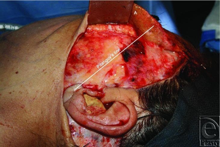 This intraoperative clinical photograph captures a surgical dissection during a deep-plane rhytidectomy (facelift) in the preauricular and temporal region. The image illustrates the anatomical relationship between tissue layers and the facial nerve. A skin flap, labeled 'A', is retracted superiorly, revealing the superficial musculoaponeurotic system (SMAS) layer, labeled 'B'. Deep to the elevated SMAS, the temporal (frontal) division of the facial nerve is identified by white arrowheads as it courses over the zygomatic arch (marked with arrows). A white annotation line represents Pitanguy's line, a surgical landmark extending from the tragus to a point 1.5 cm above the lateral eyebrow, used to estimate the trajectory of the frontal branch of the facial nerve. The photograph highlights an anatomical variation where the nerve emerges more posteriorly than typically reported. The surgical field includes the external ear with packing, local hemostasis, and surrounding surgical drapes. This visual is used to teach surgical anatomy, flap elevation techniques, and the importance of nerve preservation during aesthetic maxillofacial or plastic surgery.