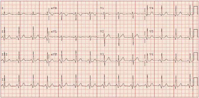 A standard 12-lead electrocardiogram (ECG) displayed on a red grid background with a rhythm strip (Lead II) at the bottom. The tracing demonstrates a normal sinus rhythm characterized by regular P waves preceding every QRS complex. The QRS complexes are narrow and uniform in morphology. Key findings include a slightly shortened PR interval and minimal, non-specific ST-segment depression localized in the inferior leads (II, III, and aVF). The T-waves remain generally upright across the precordial and limb leads, without evidence of significant inversion or hyperacute changes. The R-wave progression in the precordial leads (V1-V6) is normal. This diagnostic image is representative of basic cardiac electrophysiology monitoring, often used to assess for ischemia, conduction delays, or baseline rhythm disturbances in a clinical setting.