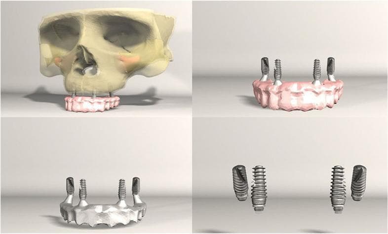 This four-panel anatomical diagram presents a 3D digital model illustrating the structural configuration of dental implants for an 'All-on-4' prosthetic rehabilitation. The upper-left panel shows the complete model with a semi-transparent human maxilla and skull, demonstrating the integration of the dental arch prosthesis and four titanium implants into the alveolar bone. The remaining panels provide isolated views of the prosthetic superstructure and the implant components. The configuration consists of four implants in total: two anterior implants positioned vertically (0° angulation) and two posterior implants tilted distally at an approximate 30° angle. This distal tilting is a common biomechanical strategy to avoid the maxillary sinus while providing a wider prosthetic base to support the dental arch. The diagram serves as an educational tool for dental students and maxillofacial surgeons to visualize implant angulation, spatial distribution within the jawbone, and the relationship between the surgical hardware and the final prosthetic restoration.