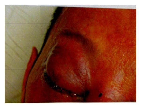 Clinical photograph of the right periorbital and midface region demonstrating features of preseptal cellulitis. The image shows significant erythema and marked edema (swelling) extending across the forehead, nose, and periorbital areas. The right upper and lower eyelids are severely edematous, characterized by chemosis (conjunctival swelling) that restricts the visualization of the globe. A prominent yellowish crust is visible along the lid margins, suggesting the presence of dried purulent exudate or discharge. The skin appears tense and inflamed, consistent with an acute infectious or inflammatory process. This visual serves as an educational example of the clinical presentation of orbital or preseptal infections and the associated soft tissue manifestations such as eyelid crusting and severe chemosis.