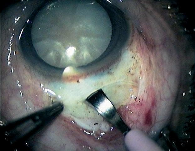 This clinical photograph captures a surgical field during an ophthalmic procedure, specifically the construction of a sclerocorneal tunnel incision for manual small incision cataract surgery (MSICS). The image shows the eye of a patient with a mature, white, opaque cataract visible through the dilated pupil. Surgical instruments are in active use: toothed forceps are seen stabilizing the sclera on the left, while a metal crescent knife is performing a partial-thickness lamellar dissection into the sclera near the limbus. The depth of the tunnel is being monitored by the visibility of the crescent blade through the overlying scleral fibers, a critical step to ensure a self-sealing wound and avoid perforation. The surrounding conjunctiva shows mild surgical hyperemia. This image serves as a teaching tool for ocular surgery, illustrating proper instrument positioning and tissue handling for creating the entry point into the anterior chamber during cataract extraction.