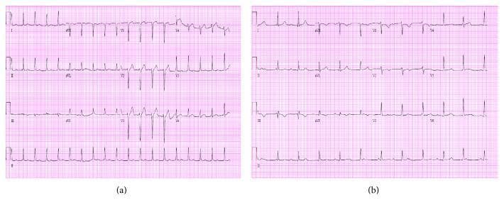 This diagnostic image presents a side-by-side comparison of two 12-lead electrocardiograms (ECGs) demonstrating the progression of conduction disease. The left panel (Day 1) shows a sinus tachycardia with a rate of 111 bpm. Notable features include a consistently prolonged PR interval, indicating a first-degree atrioventricular (AV) block. The right panel (Day 2) displays a significant clinical evolution to a third-degree (complete) heart block. Key diagnostic findings in the second ECG include complete AV dissociation, where P waves and QRS complexes occur independently of each other. The atrial rate is faster than the ventricular rate, which has slowed to 67 bpm with a regular R-R interval, suggesting a stable escape rhythm. This comparison illustrates the dynamic nature of electrical conduction abnormalities in acute clinical settings, such as infective endocarditis where paravalvular abscess formation may compromise the conduction system. The ECGs include standard limb leads (I, II, III), augmented leads (aVR, aVL, aVF), and precordial leads (V1-V6).