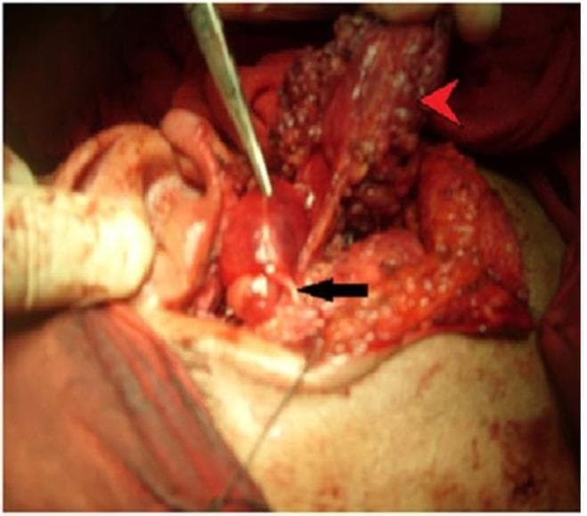 Clinical intraoperative photograph of the left parotid region during a parotidectomy. The surgical field demonstrates the relationship between a focal mass and the facial nerve. A red arrowhead indicates the retracted superficial lobe of the parotid gland, revealing granular glandular tissue. Centrally, a well-circumscribed, smooth-walled mass is visible. A black arrow points to the superior division of the facial nerve, which appears as a thin, white, fibrous strand directly coursing over and becoming encased within the mass. A metal surgical dissector is shown at the superior aspect of the lesion to facilitate exposure. This visual demonstrates the surgical anatomy of a facial nerve neurofibroma and the technical challenge of nerve preservation when a neoplasm incorporates nerve fascicles. Key landmarks include the auricle (left) and the dissected surgical bed with associated soft tissue and vascularity.