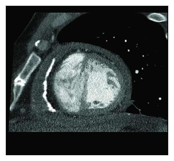An axial non-contrast CT scan of the thorax focusing on the heart and mediastinum. The image demonstrates a diagnostic hallmark of constrictive pericarditis. The primary visual finding is a significantly thickened and fibrotic pericardium encircling the cardiac silhouette. Extensive, high-density calcifications are visible within the anterior and lateral pericardial layers, appearing as bright, opaque linear and curvilinear structures. These calcified plaques are prominently situated over the right and left ventricular surfaces. The cardiac chambers appear compressed or restricted by the rigid, thickened pericardial shell. Surrounding anatomical landmarks include the sternum anteriorly and portions of the lung parenchyma laterally. This imaging is clinically significant for evaluating chronic constrictive pericarditis, illustrating the characteristic 'armored heart' (pericarditis calculosa) which leads to impaired diastolic filling and clinical signs of heart failure.