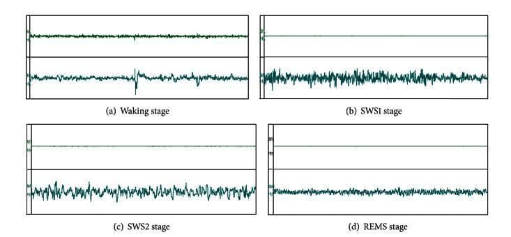 This diagnostic comparison chart displays four panels of synchronized Electromyography (EMG) and Electroencephalography (EEG) tracings, illustrating different physiological states in a sleep-wake cycle. The panels represent: (a) Waking stage, (b) Slow-Wave Sleep 1 (SWS1), (c) Slow-Wave Sleep 2 (SWS2), and (d) Rapid Eye Movement Sleep (REMS). Each panel contains an EMG trace in the upper half and an EEG trace in the lower half. In the Waking stage, the EMG shows moderate tonic activity while the EEG is relatively low-amplitude. Transitions into SWS1 and SWS2 demonstrate a progressive increase in EEG amplitude and irregularity, characterized by higher voltage and slower waves (peaks and valleys), while the EMG maintains some activity. The REMS stage is marked by a distinctive EMG 'flatline' or muscle atonia (quiescence), contrasted with a desynchronized, lower-amplitude EEG signal. These visual biomarkers are critical for neurophysiological sleep staging, polysomnography research, and evaluating the effects of pharmacological interventions on sleep architecture and central nervous system activity.