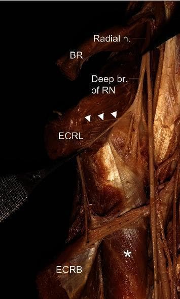 This clinical photograph displays a detailed anatomical dissection of the human forearm, focusing on the peripheral nervous system and musculature of the radial compartment. The image highlights the branching pattern of the radial nerve (Radial n.) as it descends. Key muscular structures identified include the brachioradialis (BR) positioned superiorly, the extensor carpi radialis longus (ECRL) located centrally, and the extensor carpi radialis brevis (ECRB) situated distally. The supinator muscle is visible and marked with an asterisk (*). A critical neurovascular feature demonstrated is the deep branch of the radial nerve (Deep br. of RN), with white arrowheads indicating its course along the ECRL. This anatomical specimen illustrates the relationship between the radial nerve and the muscles it innervates, which is essential for understanding radial tunnel syndrome and nerve entrapment pathophysiology. The image serves as an educational resource for medical students and surgeons studying the anatomy of the upper limb and peripheral nerve distribution.