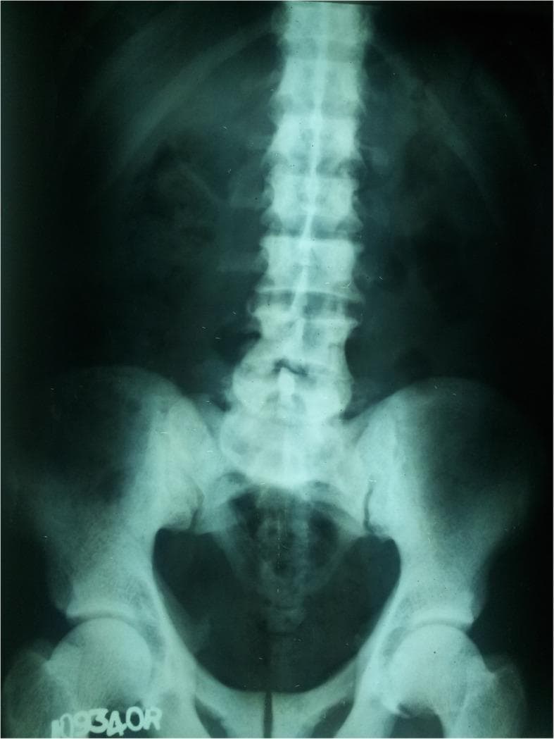 This diagnostic image is an anteroposterior (AP) X-ray of the lumbosacral spine and pelvis. The radiograph demonstrates a diffuse and marked increase in bone density (osteosclerosis) involving the lumbar vertebrae, sacrum, and pelvic bones, including the iliac wings and proximal femora. The affected bony structures exhibit a characteristic hyper-radiopaque or 'whitened' appearance with a significant loss of the normal trabecular pattern and corticomedullary differentiation. The vertebral bodies appear uniformly dense and chalk-like. In the clinical context of distal renal tubular acidosis (dRTA) and metabolic bone disease, these findings are consistent with sclerotic changes secondary to renal osteodystrophy or potential fluorosis. The alignment of the spine appears relatively preserved, and no acute fractures or focal lytic lesions are visible in this view. The image serves as a teaching example of generalized osteosclerosis in metabolic or renal systemic disease.