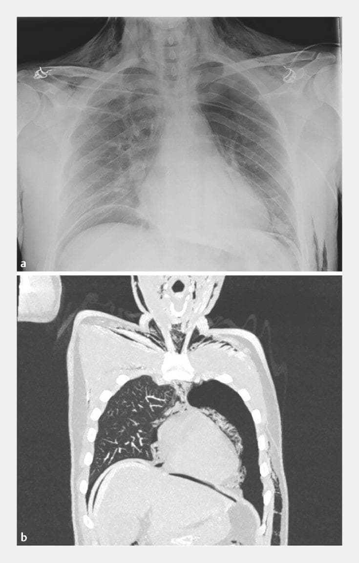 This composite figure displays diagnostic imaging of a patient exhibiting extensive extra-alveolar air following a Peroral Endoscopic Myotomy (POEM) procedure. Image A is a frontal chest X-ray demonstrating a large crescentic lucency beneath the diaphragm consistent with pneumoperitoneum, linear lucencies along the mediastinal borders indicating pneumomediastinum, and radiolucent striations in the soft tissues of the neck and chest wall signifying subcutaneous emphysema. Image B is a coronal CT scan reconstruction of the chest and upper abdomen, providing definitive visualization of a large left-sided pneumothorax with partial lung collapse. It further confirms pneumomediastinum with air tracking around the heart and great vessels, pneumoperitoneum with free air localized under the diaphragmatic domes, and extensive subcutaneous emphysema dissecting through the cervical and thoracic muscle planes. The images collectively illustrate common barotrauma or insufflation-related complications associated with endoscopic esophageal interventions.