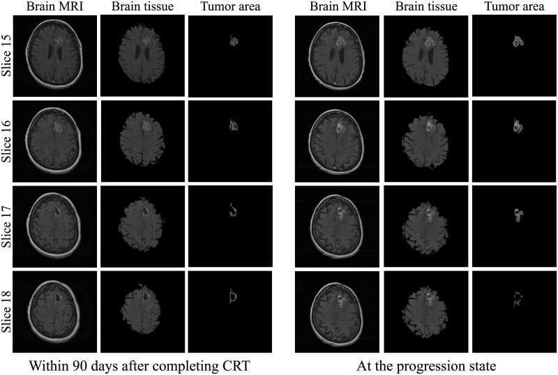 This Comparison Chart displays serial axial T1-weighted post-contrast MRI slices (Slices 15–18) of a patient with glioblastoma, comparing two clinical time points: 'Within 90 days after completing CRT' and 'At the progression state'. The layout is organized into three columns for each state: 'Brain MRI' (standard imaging), 'Brain tissue' (segmented parenchyma), and 'Tumor area' (isolated segmentation of the lesion).