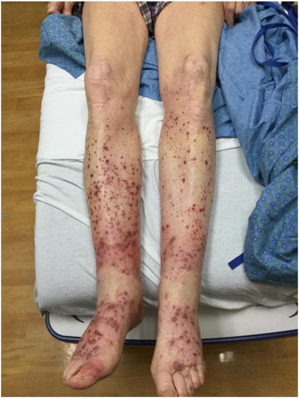 This clinical photograph displays a bilateral dermatological presentation on the lower extremities of a patient. The primary finding is widespread palpable purpura, appearing as non-blanching, reddish-purple to violaceous papules and macules. The distribution is symmetric, extending from the dorsal and plantar surfaces of the feet and ankles proximally toward the knees, involving both the anterior and posterior surfaces of the legs. The lesions vary in size and morphology, ranging from small petechiae to larger, confluent purpuric patches. The density of the eruption is highest in the distal regions (ankles and shins), gradually thinning out near the infrapatellar area. This visual presentation is characteristic of small-vessel vasculitis or cutaneous manifestations of systemic infections. In this specific clinical context, the findings represent a rare cutaneous vasculopathy associated with Varicella-zoster virus (VZV) infection. The image serves as a clinical example for students and practitioners to recognize the morphology and dependent distribution of palpable purpura.