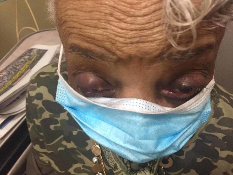 This clinical photograph shows the periocular region of an elderly patient with a darker complexion, displaying bilateral upper eyelid swelling consistent with chalazia. Both upper eyelids exhibit focal, nodular lesions with overlying erythema and a purplish discoloration, suggesting secondary inflammation. The lesion on the right upper eyelid is significantly larger and more protuberant than the one on the left, causing more pronounced distention of the palpebral tissue. The surrounding forehead skin shows deep rhythmic rhytids (wrinkles), indicative of the patient's age. The lower face is partially covered by a light blue surgical mask. This image illustrates the typical clinical presentation of chronic meibomian gland obstruction (chalazion) when occurring bilaterally with asymmetric progression. It serves as a pedagogical tool for ophthalmological and primary care physical examination findings related to eyelid pathologies.