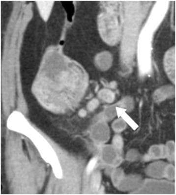 This coronal reformation CT image, taken during the portal phase with IV contrast, demonstrates an enlarged mesocolic lymph node (white arrow) in a patient with an ascending colon tumor. The lymph node measures approximately 10 x 15 mm and is located within the anatomical region most adjacent to the tumor (Region 1). Visually, the node exhibits internal heterogeneity, characterized by mixed attenuation and varying gray-scale intensities within the nodal parenchyma, which is a key morphological predictor for metastatic involvement. Despite this internal complexity, the lymph node maintains a relatively well-defined outer border. Adjacent to the lymph node cluster, the primary colonic mass is visible on the left side of the frame as a large, heterogeneous, and lobulated structure. This image serves as a clinical example of using morphological criteria, such as internal heterogeneity and border definition, rather than size alone, to evaluate lymph node status and predict stage III disease in colorectal cancer patients.