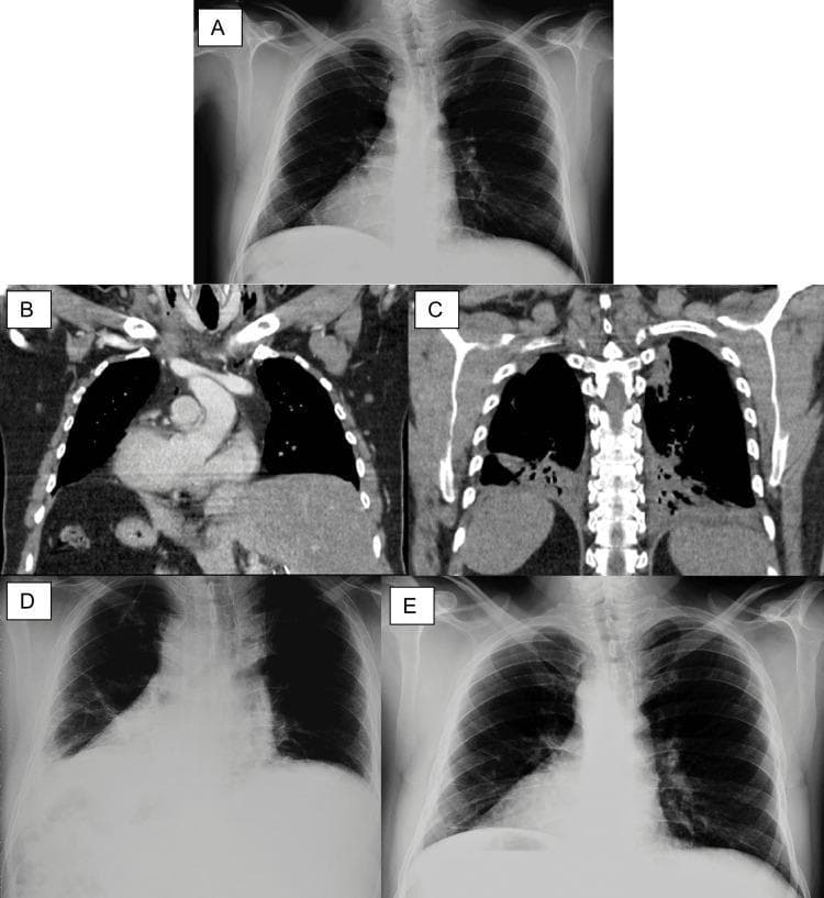 This composite figure displays a series of thoracic and abdominal imaging modalities illustrating Situs Inversus Totalis (SIT) and postoperative pulmonary complications. Image A is a preoperative posterior-anterior chest X-ray clearly demonstrating dextrocardia. Images B and C are coronal sections of a contrast-enhanced thoracoabdominal CT scan. Image B shows the heart apex pointing to the right (dextrocardia), with the liver in the left hypochondrium and the stomach in the right hypochondrium, diagnostic of SIT. Image C, a posterior coronal section, reveals bilateral posterobasal consolidations, basal atelectasis, and incipient bilateral pleural effusion. Images D and E are postoperative serial chest X-rays. Image D, taken 48 hours post-conservative management, shows significant but incomplete improvement with a persistent right-sided pleural effusion causing basal opacity. Image E is a follow-up X-ray showing full resolution of the atelectasis and pleural effusion, with clear lung fields and sharp costophrenic angles. The series provides an educational overview of the radiological presentation of complete organ transposition and the progression/resolution of secondary pulmonary atelectasis and effusion.
