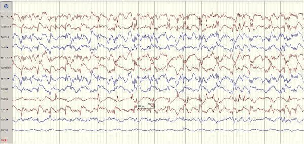 This diagnostic image displays a 12-channel electroencephalogram (EEG) recording showing significant pathological brain activity. The recording utilizes a longitudinal bipolar montage with labels including Fp1-T3, T3-O1, Fp2-T4, T4-O2, Fp1-C3, C3-O1, Fp2-C4, C4-O2, T3-C3, C3-Cz, Cz-C4, and C4-T4. The waveforms are organized in alternating red and blue traces against a vertical grid representing time intervals. The visual findings are characterized by high-amplitude, generalized discharges including frequent spikes, sharp waves, and irregular slow-wave complexes. There is a notable lack of normal background synchronicity, with chaotic and paroxysmal activity present across all frontal, temporal, and central derivations. These features are clinically indicative of generalized seizure activity (ictal state). The tracing demonstrates high-voltage electrical instability and rhythmic discharges consistent with a drug-induced or spontaneous epileptiform event. The image serves as an educational tool for identifying disorganized EEG patterns, spike-and-wave morphology, and the electrographic manifestation of generalized seizures in a neurodiagnostic context.