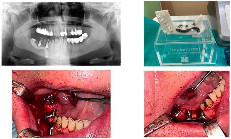 A four-panel composite image documenting the rehabilitation of a terminal edentation in the right mandible (missing teeth 4.5 to 4.8) using a custom-made partially subperiosteal implant. Top left: An orthopantomogram (OPG) shows the radiopaque metallic implant framework secured to the right posterior mandible with multiple osteosynthesis screws, featuring vertical abutment posts for prosthetic attachment. Top right: A 3D-printed anatomical model of the mandible displays the custom CAD/CAM implant framework seated on the alveolar ridge, highlighting its patient-specific morphology. Bottom panels: Intraoperative clinical photographs show the surgical placement of the implant. The metal framework is visible atop the mandibular bone, stabilized by screws within a reflected mucoperiosteal flap. The images demonstrate the close relationship between the custom implant and the remaining natural dentition, with surgical retractors and mirrors providing site exposure. This visual sequence illustrates the workflow from radiological planning to the surgical implementation of subperiosteal implant technology in oral and maxillofacial surgery.