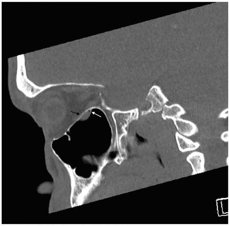 This diagnostic image is a sagittal non-contrast CT scan of the orbit and midface presented in a bone window. The image demonstrates a subtle blowout fracture of the orbital floor. Key findings include a focal bony defect (indicated by a black arrow) in the orbital floor, representing a 'trapdoor' type fracture. Immediately inferior to this defect, a soft tissue density is visible prolapsing into the superior aspect of the maxillary sinus. A small focus of orbital emphysema (intraorbital air), highlighted by a white arrow, is situated adjacent to this herniated soft tissue. The appearance is highly suggestive of orbital fat and inferior rectus muscle entrapment, which often presents clinically with vertical diplopia and restricted ocular motility. This educational visual emphasizes the importance of identifying subtle radiological signs of orbital trauma, particularly when gross fractures are absent, to prevent permanent muscle ischemia or gaze restriction.