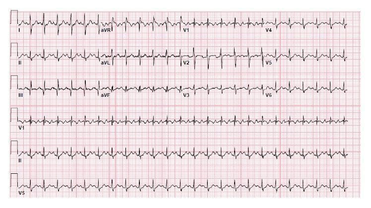 This diagnostic image is a 12-lead electrocardiogram (ECG) recorded at standard speed and voltage. The tracing demonstrates sinus tachycardia, characterized by a rapid heart rate with present P waves preceding each QRS complex. The most clinically significant finding is the 'S1Q3T3' pattern, a classic sign of right ventricular strain. This is visually evidenced by a prominent, deep S wave in Lead I, a discernible Q wave in Lead III, and an inverted T wave in Lead III. Additionally, the precordial leads (V1-V6) show T-wave inversions and ST-segment changes, further supporting a right heart pressure overload morphology. This specific combination of findings is strongly associated with acute pulmonary embolism and right heart strain in the appropriate clinical context. The ECG includes a long rhythm strip at the bottom (Leads V1, II, and V5) to facilitate rate and rhythm analysis.