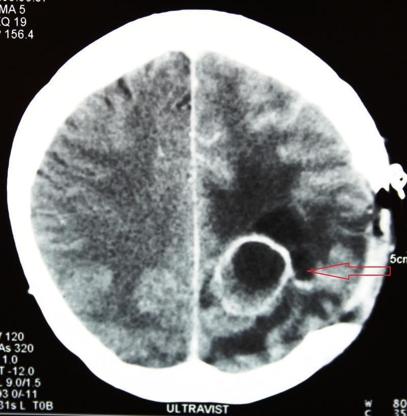 This diagnostic axial CT scan of the brain demonstrates a postoperative view of the left parieto-occipital region. The primary finding is a well-defined, ring-enhancing encapsulated lesion (indicated by a red arrow), characteristic of a recurrent or new brain abscess. The lesion features a central core of marked hypodensity, representing purulent material or liquefactive necrosis, surrounded by a dense, hyperattenuating fibrous capsule. Significant vasogenic perifocal edema is visible as an extensive, ill-defined area of low attenuation in the adjacent white matter, which results in the effacement of regional cortical sulci. Evidence of a prior craniotomy is visible on the left side of the skull vault. This image is an educational example of the radiological progression of actinomycosis or similar bacterial infections in the central nervous system, highlighting the stages of abscess encapsulation and the associated mass effect on the surrounding parenchyma.