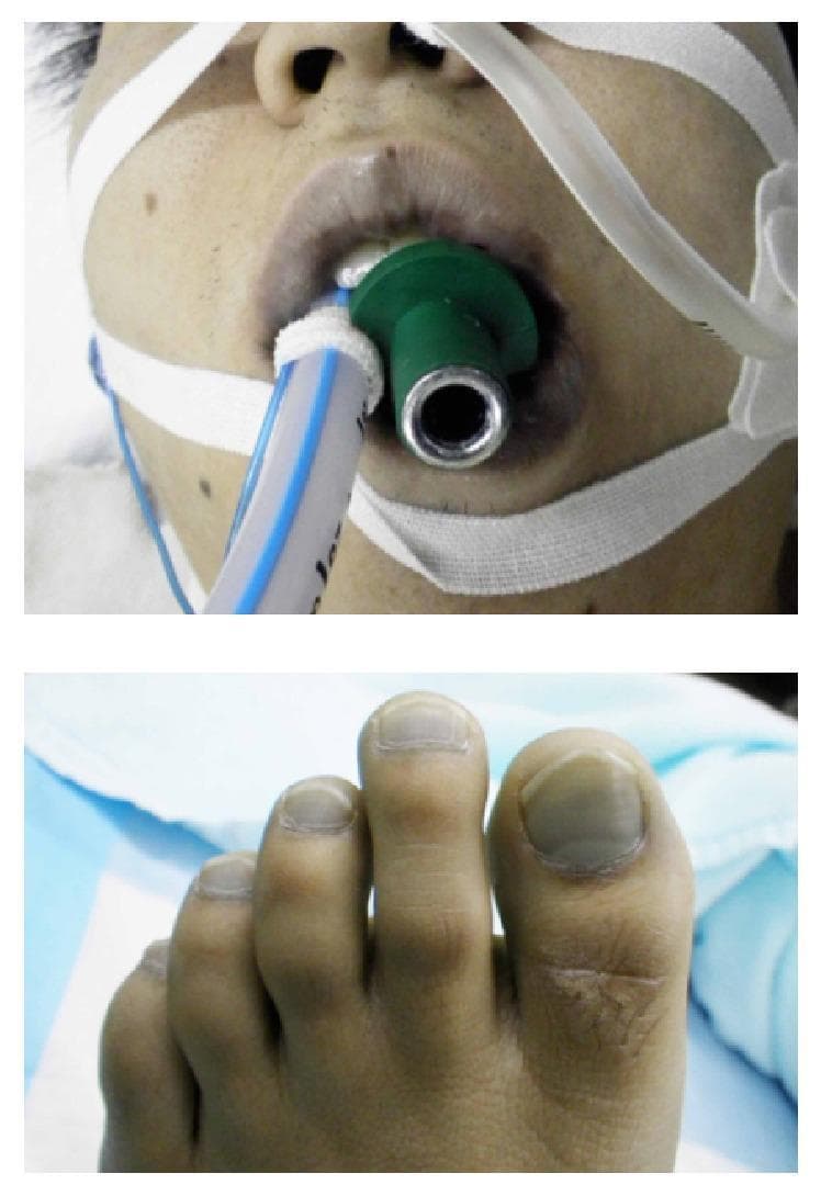 This composite clinical photograph illustrates severe central and peripheral cyanosis in a patient. The top image shows the perioral region and lower face, characterized by a profound blue-gray discoloration of the lips and surrounding skin. A green bite block and an endotracheal tube are visible, secured with white medical tape, indicating emergency airway management and mechanical ventilation. The bottom image displays the patient's foot, where the nail beds of the toes exhibit a matching slate-blue or dusky hue, characteristic of peripheral cyanosis. These visual findings are consistent with methemoglobinemia, a condition where an abnormal level of methemoglobin in the blood reduces its oxygen-carrying capacity, leading to 'chocolate-colored' blood and apparent cyanosis that does not improve with supplemental oxygen. The educational focus is on identifying clinical signs of hypoxia or hemoglobinopathies in an emergency critical care setting.