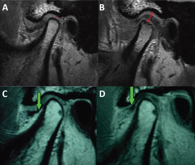 This diagnostic image collection displays four sagittal Magnetic Resonance Imaging (MRI) scans of the human temporomandibular joint (TMJ), categorized into preoperative (A, C) and postoperative (B, D) stages following arthroscopic disc repositioning or plication. Panels A and C demonstrate internal derangement characterized by anterior disc displacement and significant reduction of the superior joint space. Panels B and D illustrate successful postoperative outcomes, showing the articular disc restored to its functional position superior to the mandibular condyle. Red annotations in panel B highlight the achieved joint decompression and increased vertical joint space. Green arrows in panels C and D track the change in disc location from an anteriorly displaced state to a corrected anatomical position. The educational focus is on the radiographic evaluation of TMJ arthropathy, specifically assessing disc-condyle relationships and joint space dimensions before and after surgical intervention. These images are clinically relevant for oral and maxillofacial surgery and radiology education, demonstrating successful disc repositioning and the resulting decompression of joint tissues.