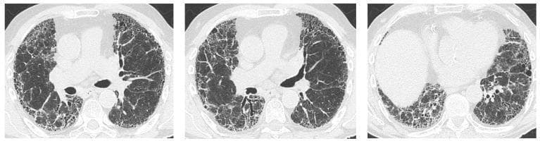 High-resolution computed tomography (HRCT) of the chest in three axial views demonstrating a classic Usual Interstitial Pneumonia (UIP) pattern. The images show bilateral, predominantly peripheral, and subpleural lung disease. Key diagnostic features include honeycombing, characterized by clusters of cystic airspaces with thick, well-defined walls, and significant traction bronchiectasis, where the fibrotic lung parenchyma pulls on and dilates the airways. These findings result in extensive architectural distortion of the lung fields, particularly in the lower lobes and subpleural regions. This diagnostic imaging is characteristic of advanced interstitial lung disease (ILD), often seen in conditions such as primary Sjögren's syndrome (pSS) or idiopathic pulmonary fibrosis. The visualization is essential for distinguishing UIP from other interstitial patterns like non-specific interstitial pneumonia (NSIP) or organizing pneumonia (OP) in clinical practice.