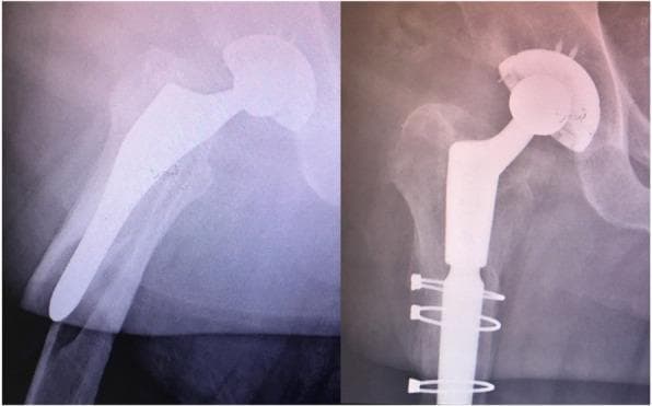 This dual-panel diagnostic image features anteroposterior X-ray radiographs of the hip and proximal femur, demonstrating the surgical management of a periprosthetic femur fracture. The left panel shows a pre-operative state with a Vancouver B2 'reverse clamshell' fracture pattern around an existing primary femoral stem; the fracture involves the lateral cortex with supero-lateral displacement of the proximal fragment. The right panel displays the post-operative results of a revision hip arthroplasty. Key radiographic features include the replacement of the original prosthesis with a long, distal-bearing revision femoral stem for enhanced stability. Orthopedic hardware for fracture fixation is prominent, specifically multiple cerclage wires encircling the proximal femoral shaft to anatomically reduce and stabilize the fracture fragments. The image serves as an educational example of managing periprosthetic fractures through component revision and internal fixation to achieve bone union and mechanical stability in orthopedic surgery.
