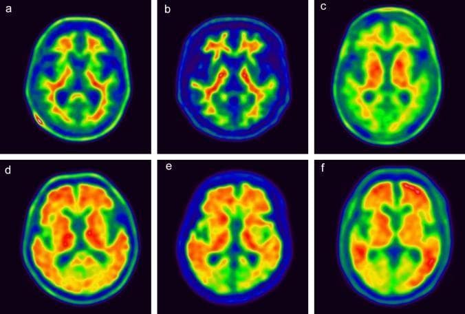 This Comparison Chart displays axial brain PET (Positron Emission Tomography) scans using three different amyloid-targeting radiopharmaceuticals: Florbetaben (FBB, panels a/d), Flutemetamol (FMM, panels b/e), and Florbetapir (FPN, panels c/f). The images are arranged to compare negative scans (upper row: a, b, c) with positive scans (lower row: d, e, f) using a rainbow color scale where warmer colors (red, orange, yellow) indicate higher radiopharmaceutical uptake and cooler colors (green, blue) indicate lower uptake. In the negative amyloid scans, tracer uptake is primarily localized to the white matter, maintaining a clear distinction from the cortical gray matter, which appears cool-toned. Notably, the FPN negative scan (c) shows higher striatal uptake compared to the others. In the positive scans, there is a diffuse, widespread increase in tracer uptake throughout the cortical regions (frontal, temporal, and parietal lobes), leading to a loss of the normal gray-white matter differentiation. This series illustrates the diagnostic visual markers for amyloid plaque deposition in Alzheimer's disease assessment across different PET tracers.