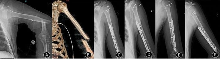 A multi-modal series of six images (A-F) documenting the clinical progression of complex orthopedic trauma. Panel A: Plain radiograph of the left shoulder and humerus showing an anterior glenohumeral dislocation associated with a fracture of the greater tuberosity and a displaced transverse fracture of the proximal-to-mid humeral shaft. Panel B: A 3D CT reconstruction demonstrating the humeral shaft fracture following successful reduction of the shoulder joint. Panels C and D: Immediate postoperative anteroposterior (AP) and lateral X-rays showing internal fixation. The shaft fracture is stabilized with a long locking compression plate (LCP) and multiple cortical/locking screws. The greater tuberosity is secured with cannulated compression screws, and radiopaque suture anchors are visible in the proximal humerus, indicating rotator cuff repair. Panels E and F: Follow-up radiographs at four months demonstrate anatomical alignment, successful maintenance of shoulder reduction, and progressive bony union (callus formation) at both fracture sites. This series serves as an educational example of managing combined shoulder dislocation-fractures through open reduction and internal fixation (ORIF).
