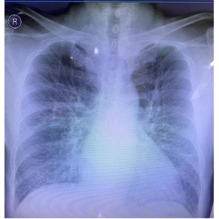 This diagnostic image is a posterior-anterior (PA) chest x-ray radiography demonstrating significant cardiomegaly and signs of pulmonary congestion. The cardiac silhouette is markedly enlarged, with a transverse diameter exceeding 50% of the thoracic width, suggesting multi-chamber enlargement. The lung fields exhibit diffuse, bilateral increased opacities with perihilar haziness and ill-defined vascular markings, characteristic of interstitial pulmonary edema. Cephalization of the pulmonary vessels is visible, further indicating elevated pulmonary venous pressure. These radiological findings are clinically significant for acute heart failure or decompensated cardiac function, likely secondary to a cardiovascular event such as myocardial infarction. The image serves as an educational example of the visual progression from cardiomegaly to impending acute lung edema in a clinical setting.