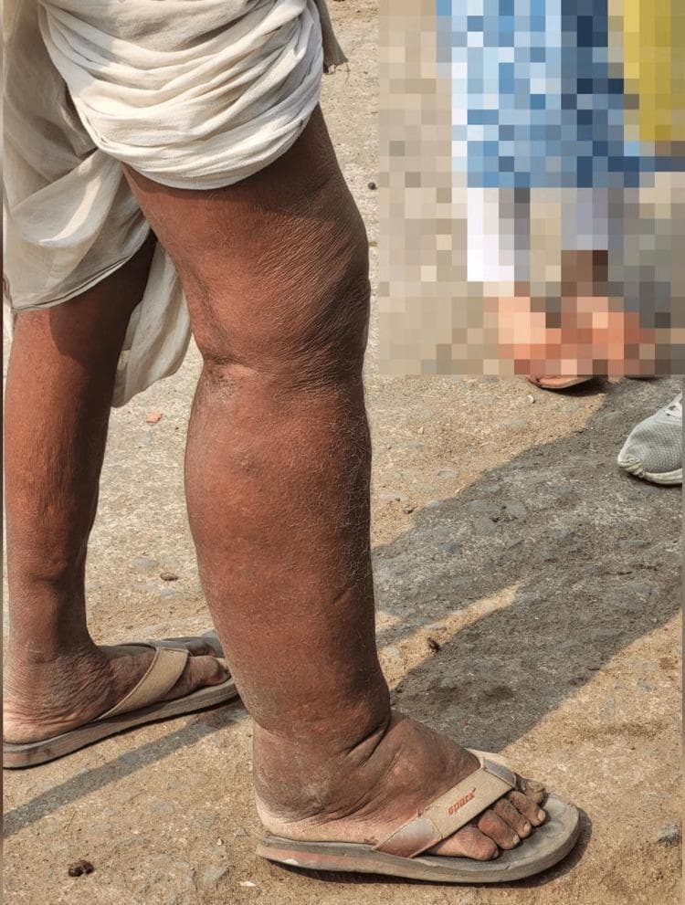 Clinical photograph of a 58-year-old male presenting with asymmetric lower extremity swelling, characteristic of chronic lymphatic filariasis (elephantiasis). The image shows a comparative view of the legs where the right lower limb exhibits advanced stage lymphedema. Key findings include massive non-pitting edema extending from the thigh to the foot, resulting in a distorted, cylindrical limb shape. The skin on the affected right leg is significantly thickened, displaying hyperkeratosis, prominent skin folds, and a rough, brawny texture (pachydermia) compared to the relatively normal appearance of the left leg. The foot shows significant swelling with obscured anatomical contours and secondary skin changes. This visual demonstrates the chronic obstructive stage of a filarial infection, where lymphostasis leads to tissue fibrosis and permanent dermal thickening. The clinical context suggests a history of recurrent adenolymphangitis in an endemic region, illustrating the progression from early pitting edema to late-stage irreversible lymphedema.