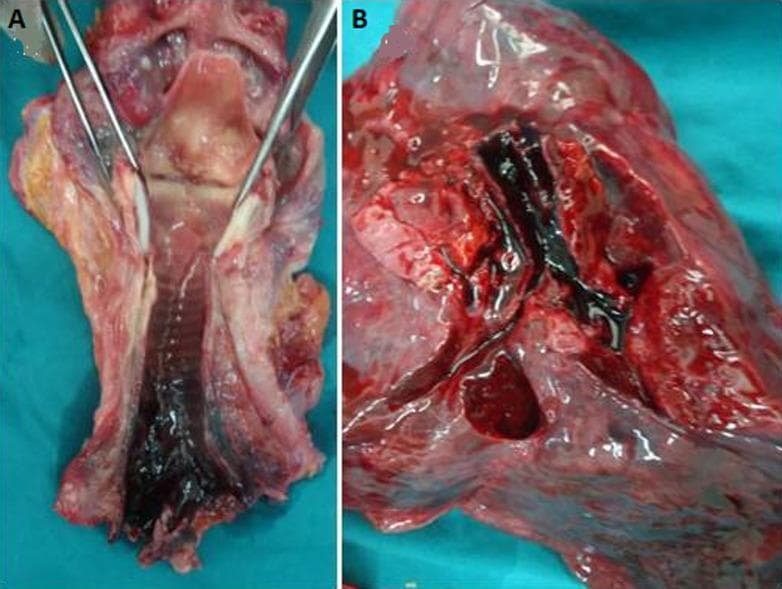 This forensic clinical photograph displays gross autopsy findings from the respiratory system of a deceased individual. Image A shows a longitudinal section of the larynx and trachea, held open with surgical forceps. The mucosa exhibits a characteristic cherry-red coloration, which is a classic post-mortem indicator of carboxyhemoglobinemia associated with carbon monoxide poisoning. Significant deposits of black, granular soot are visible lining the interior of the lower trachea. Image B shows a cross-section of pulmonary tissue, demonstrating intense congestion and a similar cherry-red hue. The primary bronchi and smaller airways contain prominent black carbonaceous material (soot). These findings collectively illustrate the pathological hallmarks of smoke inhalation and carbon monoxide toxicity, typically encountered in fire-related fatalities or enclosed-space combustion. The image serves as a teaching tool for forensic pathology, particularly in identifying indicators of vital reaction (breathing during a fire) versus post-mortem exposure.