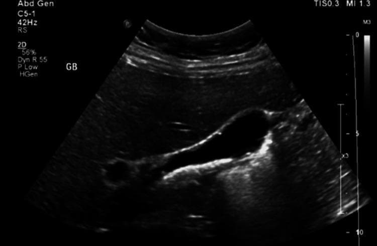 This diagnostic image is a 2D grayscale abdominal ultrasound focusing on the gallbladder (labeled 'GB'). The gallbladder is visualized as an anechoic (black) fluid-filled sac. Within the dependent portion of the gallbladder lumen, there are multiple hyperechoic (bright) mobile structures consistent with cholelithiasis (gallstones). These stones demonstrate posterior acoustic shadowing, a hallmark diagnostic feature where the sound waves are blocked by the dense stones. The gallbladder wall appears thin and regular, without obvious evidence of wall thickening, pericholecystic fluid, or other signs of acute cholecystitis. In the clinical context of situs inversus totalis, this ultrasound identifies the gallbladder positioned on the left side of the upper abdomen. This visual serves as a primary diagnostic tool for evaluating biliary colic and symptomatic cholelithiasis.