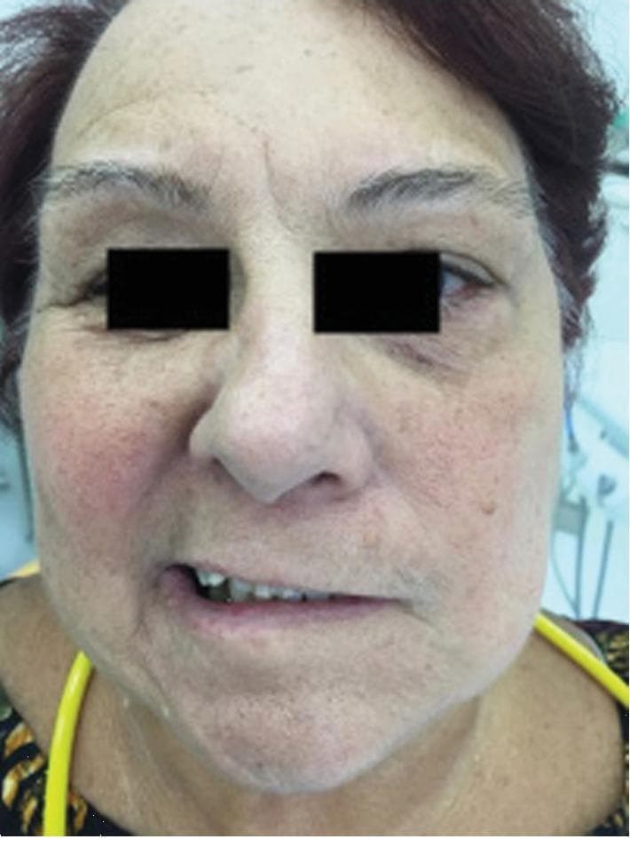 This clinical photograph displays a 71-year-old female patient with a primary presentation of Bell's palsy, demonstrating significant facial nerve (cranial nerve VII) paralysis. The image shows a frontal view of the face with the eyes obscured for privacy. Notable clinical findings include severe unilateral facial asymmetry at rest. The patient's left side exhibits a loss of muscle tone, characterized by a flattened nasolabial fold and downward drooping of the labial commissure (mouth corner). In contrast, the right side retains normal muscle contraction, causing the mouth to be pulled toward the unaffected side. This visual serves as an educational example of Grade V (severe) facial paralysis on the House-Brackmann Scale, highlighting the characteristic 'sagging' appearance and muscle weakness associated with idiopathic peripheral facial palsy before treatment. The image is a valuable tool for medical students and clinicians for recognizing diagnostic clinical signs of facial nerve dysfunction.