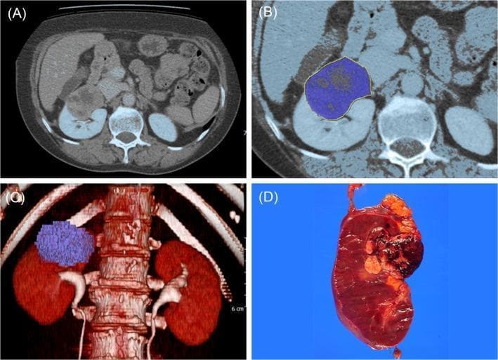 This four-panel image illustrates the correlation between preoperative radiological imaging and postoperative gross pathology for a renal cell carcinoma (RCC) case. Panel A is an axial contrast-enhanced CT scan of the abdomen showing a heterogeneously enhancing mass in the superior pole of the right kidney. Panel B demonstrates manual segmentation of the tumor, where the lesion is highlighted with a blue color overlay and a yellow boundary to delineate it from the surrounding normal renal parenchyma. Panel C provides a 3D volumetric reconstruction (VRT) of the urinary system and spine, visualizing the total tumor volume as a blue voxelized mass protruding from the right kidney. Panel D displays the corresponding gross surgical specimen following a radical nephrectomy. The bisected kidney reveals a large, dark brown, solid mass with irregular borders and focal hemorrhagic areas, consistent with the radiological findings. This educational image set highlights the process of 3D tumor volume measurement in urological oncology and its anatomical correlation with surgical findings.
