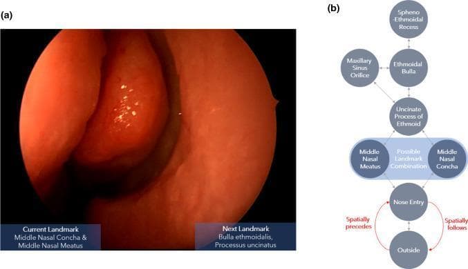 This composite educational graphic illustrates navigational landmarks and logic for Functional Endoscopic Sinus Surgery (FESS). Image (a) is a real-world clinical photograph captured during nasal endoscopy, showing a close-up view of the internal nasal anatomy. The image identifies the middle nasal concha (turbinate) and the middle nasal meatus, characterized by a healthy, reddish-orange mucosal surface with a moist, smooth texture. Image (b) is a clinical flowchart/algorithm detailing the spatial transitions between anatomical landmarks encountered during the procedure. The diagram uses a hierarchical structure to show connectivity between nodes such as the 'Outside', 'Nose Entry', 'Middle Nasal Meatus/Concha', 'Uncinate Process of Ethmoid', 'Ethmoidal Bulla', 'Maxillary Sinus Orifice', and 'Spheno-Ethmoidal Recess'. Red arrows define directional semantic relations, specifically 'spatially precedes' and 'spatially follows', which indicate the relative depth or inward/outward movement of the endoscope within the nasal cavity. This resource is designed to train surgical navigation prediction models by mapping visual anatomical landmarks to procedural pathways.