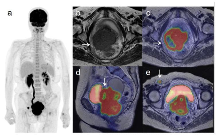 Multi-modal diagnostic imaging set demonstrating Stage IVB cervical cancer. (a) Whole-body 18F-FDG PET (Maximum Intensity Projection) displays primary hypermetabolic activity in the pelvis and metastatic uptake in a right inguinal lymph node. (b) Axial T2-weighted MRI shows a low-signal cervical mass disrupting the right cervical stroma with lateral extension into the pelvic sidewall. (c) Axial T2-weighted PET/MR fusion confirms intense FDG uptake corresponding to the invasive cervical tumor. (d) Sagittal PET/MR fusion reveals the large hypermetabolic cervical mass invading the posterior bladder wall. (e) Axial PET/MR fusion highlights the hypermetabolic right inguinal lymph node, indicating distant lymphatic metastasis. The case illustrates the utility of PET/MR in assessing local invasion (bladder, pelvic wall) and distant staging (Stage IVB) of gynecological malignancies.