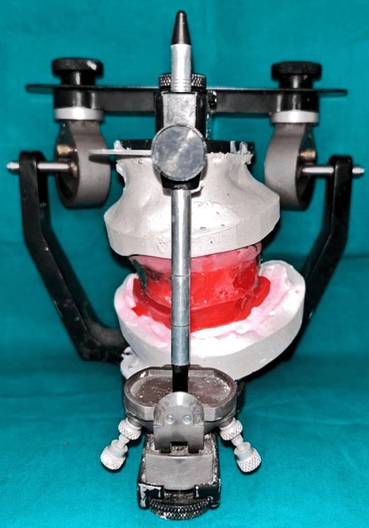 A clinical photograph depicting a Hanau Wide-Vue semi-adjustable articulator, a diagnostic and procedural tool used in prosthodontics and oral surgery. The image shows the frontal view of the device with maxillary and mandibular dental casts mounted. The articulator's upper member is connected to the lower member via a central vertical incisal pin and lateral condylar guidance mechanisms, which feature adjustable black knobs for setting condylar inclination. The maxillary (upper) and mandibular (lower) diagnostic casts are fabricated from white dental stone. Between the casts, a red and pink wax bite registration is positioned to record the maxillomandibular relationship. The setup represents a facebow transfer, utilized here to orient the maxillary cast to the articulator's hinge axis, facilitating the restoration of vertical dimension and occlusal rehabilitation in a complex implant-supported case. The clinical relevance involves pre-prosthetic planning for zygomatic and endosteal implant placement to correct severe maxillary atrophy and occlusal dysfunction.