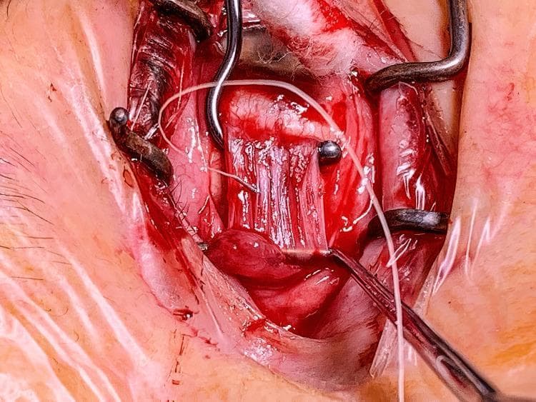 This intraoperative clinical photograph captures a surgical field during an ophthalmologic procedure, specifically a strabismus surgery involving the lateral rectus muscle. The central focus is on the lateral rectus muscle, which displays a characteristic striated, reddish-pink appearance and has been isolated and retracted. The surgical site is held open by metallic wire retractors (Desmarres or similar), providing exposure of the extraocular muscle and the underlying sclera. A notable round, nodular mass is visible attached to the belly of the muscle, representing a cyst associated with fat necrosis or foreign material such as silicone oil. Surgical sutures (likely 6-0 Vicryl or similar) are present, looped across the muscle to facilitate recession or resection manipulation. The surrounding conjunctiva and Tenon's capsule show expected surgical trauma, including minor hemorrhage and edema consistent with active dissection. This image serves as a teaching tool for identifying extraocular muscle anatomy and visualizing the surgical management of peri-muscular cystic lesions.