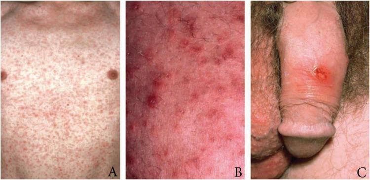 This composite of three clinical photographs illustrates the dermatological and urogenital manifestations of early syphilis (Treponema pallidum infection). Panel A shows a wide-field view of the anterior torso featuring a dense, generalized maculopapular rash, typical of secondary syphilis. The lesions are symmetric, non-confluent, and reddish-pink. Panel B provides a high-magnification view of the same rash, highlighting individual erythematous papules with distinct borders and underlying skin inflammation. Panel C depicts a primary syphilis lesion: a solitary, well-demarcated chancre on the dorsal penile shaft. The chancre presents as a round, reddish-brown ulcer with indurated edges, a clean base, and associated localized erythema. This educational visual is designed to assist in the clinical identification of primary versus secondary stages of syphilis, focusing on the transition from a localized inoculation site (chancre) to systemic cutaneous dissemination (maculopapular rash). It is intended for medical education in infectious diseases, dermatology, and sexual health.