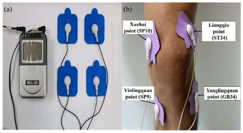 This procedural clinical photograph illustrates the application of Transcutaneous Electrical Nerve Stimulation (TENS) for knee pain management. Panel (a) shows the physical components: a handheld handheld TENS unit with a digital interface and control buttons connected via lead wires to four blue adhesive electrode pads. Panel (b) demonstrates clinical application on a patient's right knee. The four lavender-colored adhesive patches are strategically placed over specific acupuncture and anatomical landmarks to deliver electrical stimulation across the joint. The labeled electrode positions include the medial side points Xuehai (SP10) and Yinlingquan (SP9), and the lateral side points Liangqiu (ST34) and Yanglingquan (GB34). The setup is typical for non-invasive physical therapy interventions aimed at relieving chronic or acute knee pain, such as that caused by osteoarthritis, by modulating nerve signals through varying current frequencies and intensities.