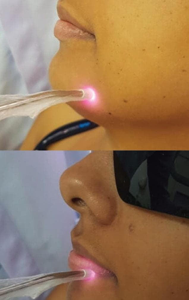 Two-panel clinical photograph demonstrating extraoral low-level laser therapy (LLLT) being applied to a patient's face for the treatment of post-surgical paresthesia. A handheld therapeutic laser device, covered in a sterile clear protective sheath for biosafety, is shown in direct contact with the skin. The first panel shows the application to the mental (chin) region, while the second shows application to the lower vermilion border and labial mucosa. A bright pinkish-red light is visible at the tip of the probe, indicating active irradiation targeting the pathways of the inferior alveolar and mental nerves. The patient is wearing protective eyewear as a safety protocol. This visual illustrates the clinical management of sensory deficits following third molar extraction, emphasizing non-invasive photobiomodulation techniques in oral and maxillofacial rehabilitation.