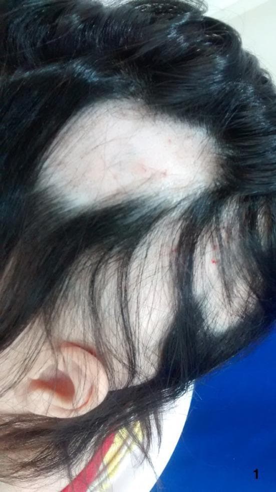 This clinical photograph shows a close-up, superior-lateral view of the scalp of a patient with severe alopecia areata. The image reveals multiple large, well-demarcated, non-scarring patches of alopecia (hair loss). The exposed scalp skin appears smooth, pale, and lacks follicular ostia plugging, which is characteristic of non-cicatricial alopecia. Within the bald patches, a few vellus hairs and some short, broken hairs are visible. Minor erythematous punctate lesions are present on the bare scalp surface, possibly related to recent intralesional treatments. The remaining hair is dark, terminal, and demonstrates normal density and length in unaffected regions. This visual presentation is typical of autoimmune hair loss, where the disease progresses from focal patches toward more extensive involvement such as alopecia totalis. The photograph serves as a clinical reference for diagnosing patchy hair loss and monitoring disease activity and treatment response in dermatological settings.