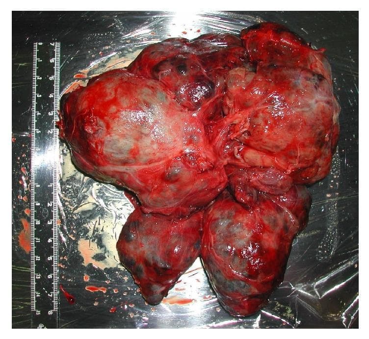 A clinical photograph of an extirpated gross surgical specimen, identified as a giant goitre (thyroid tumor) following total thyroidectomy. The specimen is a large, multi-nodular, and lobulated mass with an irregular morphology. It exhibits a predominantly dark red and fleshy appearance with variations in tissue color, suggesting heterogeneous vascularization and potentially areas of cystic change or hemorrhage. The surface is moist and glistening with evidence of adherent blood. A medical ruler placed alongside the specimen indicates its significant proportions, measuring approximately 15 cm in length and 13 cm in width, with a total weight of 515 g. This image demonstrates the massive enlargement of thyroid tissue capable of causing severe anatomical displacement, such as tracheal compression and glottic shift, which are critical considerations for anesthetic airway management. The educational focus is on gross pathology of benign thyroid disease and its surgical implications.