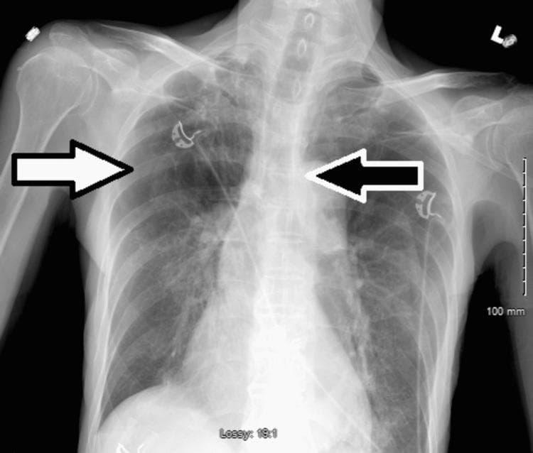 This diagnostic image is an anteroposterior (AP) chest X-ray demonstrating a large right-sided tension pneumothorax. The right hemithorax shows an extensive area of increased lucency (hyperlucency) with a complete absence of peripheral bronchovascular lung markings (indicated by the white arrow). Key diagnostic features include significant mass effect, characterized by a visible mediastinal shift to the left (indicated by the black arrow) and flattening of the right heart border and mediastinal contours. The trachea is also deviated toward the left. These findings are clinically significant as they represent a medical emergency where intrapleural pressure exceeds atmospheric pressure, compromising venous return and cardiac output. The image provides a clear example of tension physiology in the thoracic cavity following chest tube removal. The patient's background of COPD and COVID-19 pneumonia contributes to the underlying lung frailty and secondary spontaneous pneumothorax risk.
