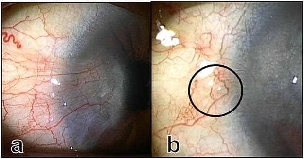 This comparison set of clinical ophthalmology photographs demonstrates the before and after states of a pterygium surgery on the nasal conjunctiva and cornea. Image (a) depicts a preoperative pterygium characterized by a fleshy, triangular fibrovascular tissue growth extending from the nasal conjunctiva over the limbus onto the corneal surface. The vascular pattern is dense and disorganized, with tortuous, engorged vessels concentrated at the pterygium head. Image (b) shows the same eye four months postoperatively following a superficial keratectomy and conjunctival repositioning. The corneal surface is clear, indicating successful removal of the fibrovascular encroachment. A black circle in image (b) highlights a specific vascular loop near the limbus, which is an anatomical hallmark of restored normal limbal vascular architecture. The surrounding conjunctival tissue appears healthy with significantly reduced inflammation and finer, more attenuated blood vessels compared to the preoperative state. These images serve as educational material for assessing surgical outcomes in ocular surface reconstruction and identifying normal versus pathological limbal vascularization.