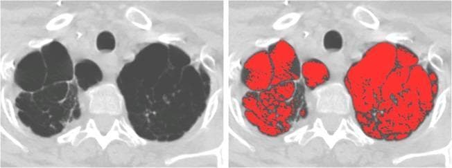 This diagnostic image consists of two panels showing axial chest CT scans of a patient with cystic fibrosis (CF) undergoing lung transplant evaluation. Panel A (left) displays the raw CT data at the level of the lung apices, showing extensive, bilateral bullous emphysema. The parenchyma is replaced by large, thin-walled, air-filled cystic spaces (bullae), with the left lung demonstrating more severe confluent destruction compared to the right. Panel B (right) shows the same image with automated densitometry quantification applied. Areas with Hounsfield Unit (HU) values below -950 (indicative of severe emphysema/air trapping) are highlighted with a red mask. This computer-aided quantification (IN-950) measured the emphysematous volume at 17.9%, correlating with a moderate histopathological score. The image illustrates the use of quantitative CT imaging in assessing obstructive lung disease and surgical candidacy in advanced pulmonary pathology.