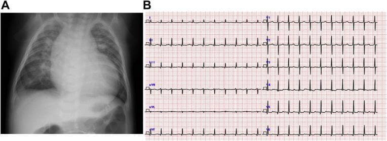 The image consists of two panels, (A) a frontal pediatric chest radiograph and (B) a standard 12-lead electrocardiogram (ECG), illustrating a case of heart failure and left ventricular hypertrophy (LVH). Panel A demonstrates significant cardiomegaly with a widened cardiac silhouette and a cardiothoracic ratio of approximately 60%. The lung fields show increased bronchovascular markings and haziness consistent with pulmonary congestion. Panel B shows a 12-lead ECG in sinus rhythm with tachycardia. Key diagnostic features for LVH are present, including high-voltage R waves in the lateral precordial leads (V5, V6) and deep, high-voltage S waves in the right precordial lead (V1). Additionally, the T waves demonstrate low voltage and inversion in several leads, suggesting ventricular strain. These visual findings together support a clinical diagnosis of pediatric cardiac dysfunction and structural hypertrophy, often associated with conditions such as aortic stenosis or coarctation of the aorta.