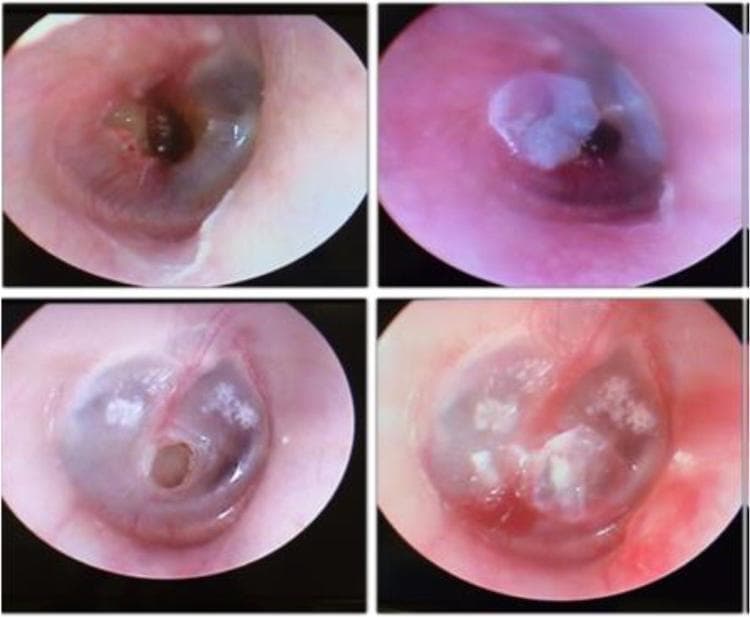 A comparison chart consisting of four video-otoscopy clinical photographs organized into two rows. The left column displays pre-treatment views of the tympanic membrane in two different patients, each exhibiting a clear central perforation. In the top left image, a medium-sized irregular perforation is visible with mildly inflamed margins. In the bottom left image, a smaller, circular, well-defined central perforation is seen in a membrane showing signs of myringosclerosis (white calcific plaques). The right column shows the same ears post-procedure, demonstrating the temporary closure of the defects using a translucent Bionext® cellulose film. The film is visible as an opaque-to-translucent patch covering the previous perforation sites, effectively sealing the middle ear space from the external auditory canal. This visual comparison illustrates a conservative clinical approach to managing symptomatic tympanic membrane perforations to assess immediate functional and symptomatic improvement before considering permanent surgical repair like myringoplasty.